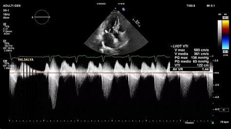 lvot peak gradient at rest